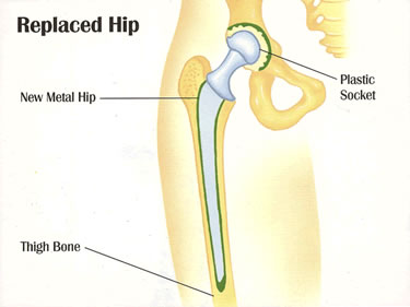 Illustration of a Replaced Hip. Please click here to enlarge this image.