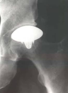 Partial Resurfacing of the Hip (x-ray image).