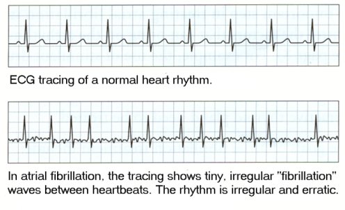 Normal and A-Fib EKG