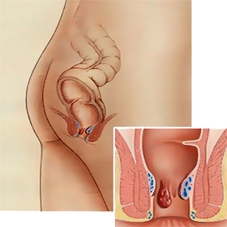 Can Viagra Aggravate Hemorrhoids
