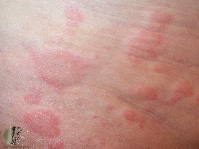 Contact Urticaria Syndrome: Background, Pathophysiology ...