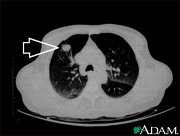 Lung mass, right upper lobe - CT scan