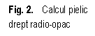 Text Box: . 2.   Calcul pielic drept radio-opac