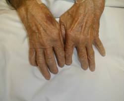 Rheumatoid arthritis