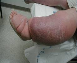 venous ulcer5