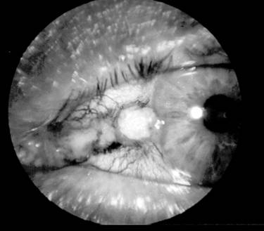 Care este tratamentul chirurgical al cataractei cu urmărirea femto