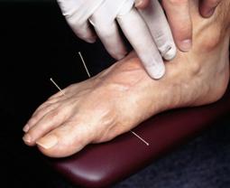 Acupuncture21.jpg