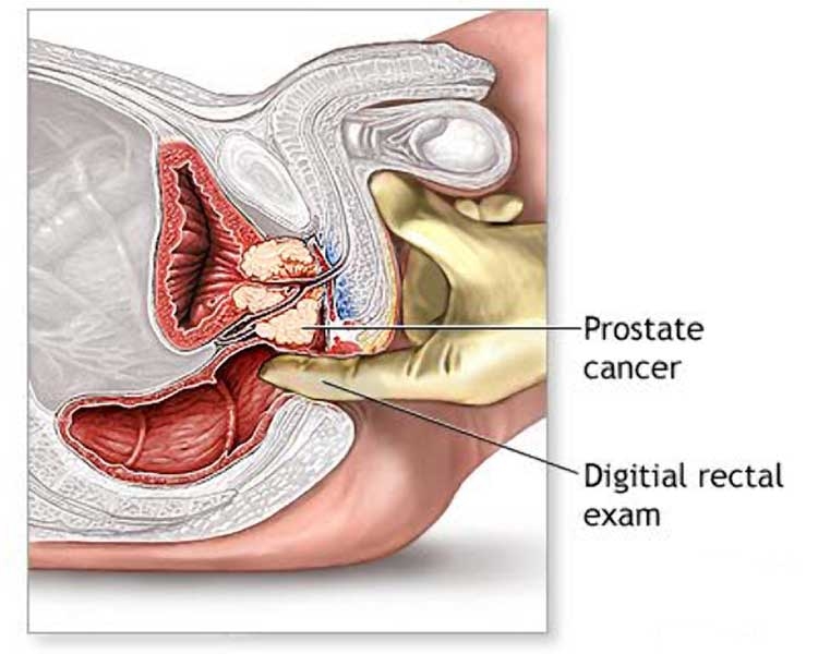 Junghi in zona prostatei barbati