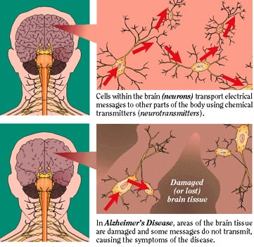 Alzheimer disease (dementia)