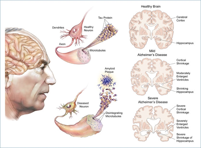 poza despre alzheimer