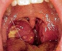 Amigdalita cronica si vegetatiile adenoide