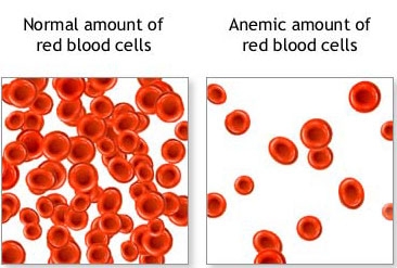 imagine cu anemia