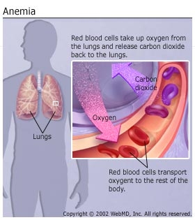 Iron deficiency anemia (microcytic hypochromic anemia)