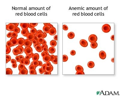 Anemii hipocrome microcitare