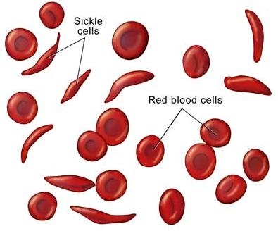 Aspecte de geropatologie a singelui - anemiile