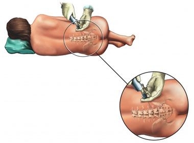 Transplantul medular si anestezia - anestezia pentru recoltarea maduvei osoase