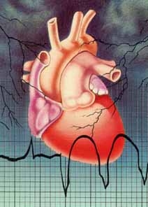 Anevrismul  leziune vasculara care genereaza avc