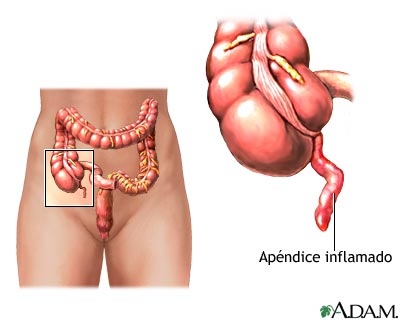 Apendicele si apendicita (durerea si tratamentu apendicitei)