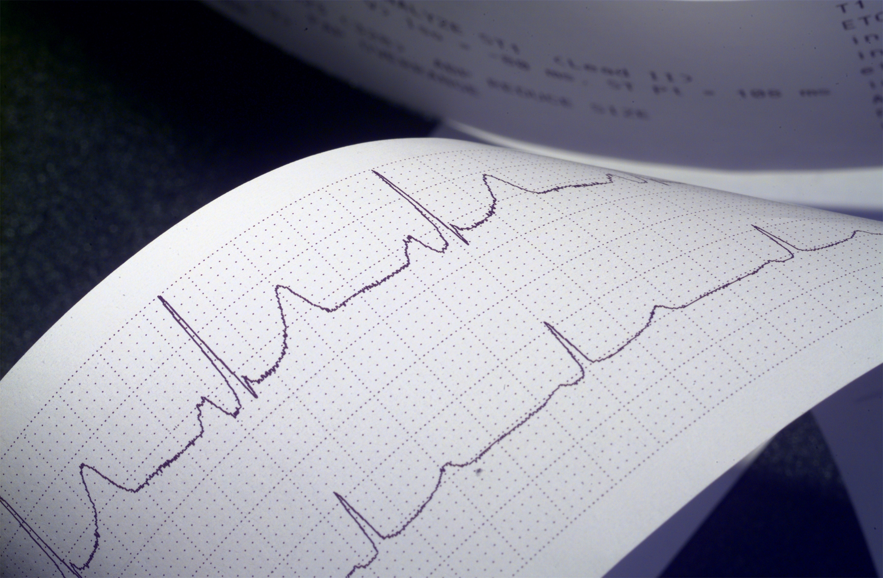 Hemodinamica, simptomatologia si tratamentul principalelor aritmii cardiace