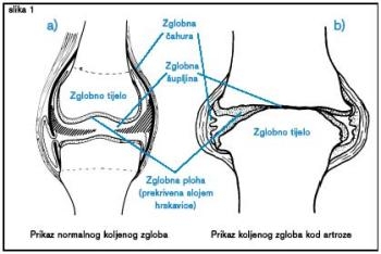 Artroza genunchiului