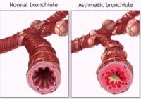 Astmul si pneumonia prin hipersensibilizare