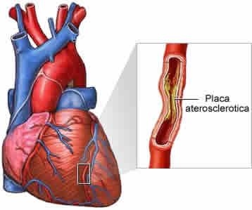 Ateroscleroza si boala coronariana