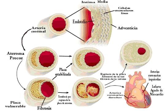 Ateroscleroza cerebrala