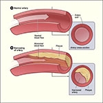 imagini aterosclerozei