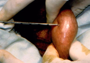 Biopsia hepatica percutana