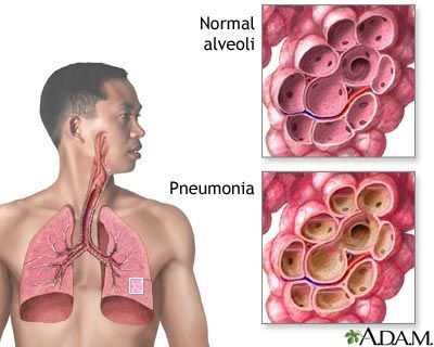 Bronhopneumonia si pneumonia pneumococica