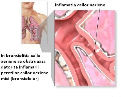 Gripa, bronsiolita si bronsita, pneumonia