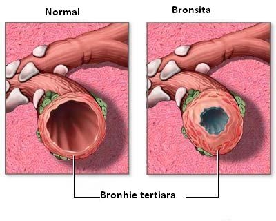 Traheobonsita - bronsita