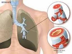 Bronsita astmatiforma