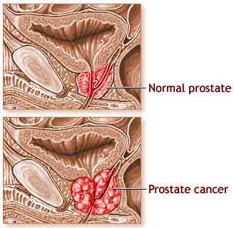 Adenom de prostata : Cauze, simptome si tratament