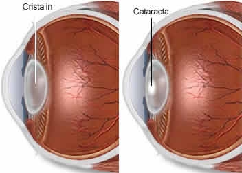 imagine cu cataracta