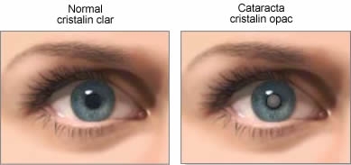 Cataracta