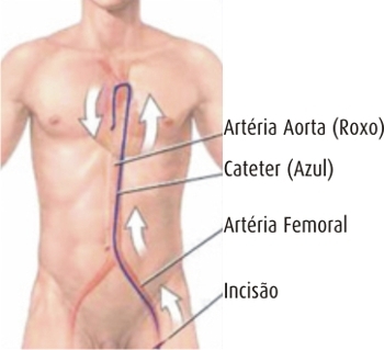 Cateterismul si coronarografia