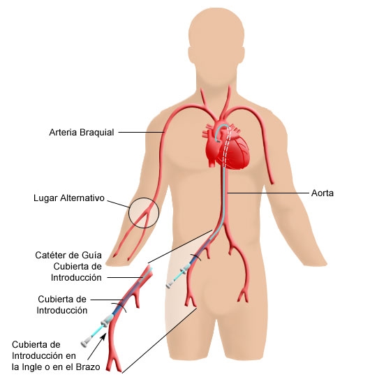 imagini cateterismul