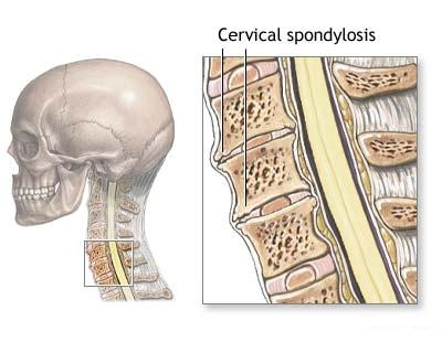 Evcrsiune sau eroziune cervicala