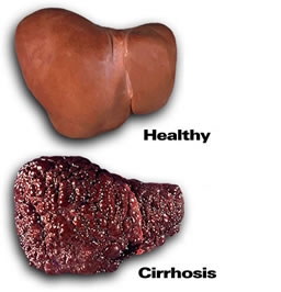 Ciroza si bolile hepatice alcoolice