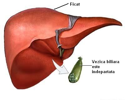 imagini colecistectomie