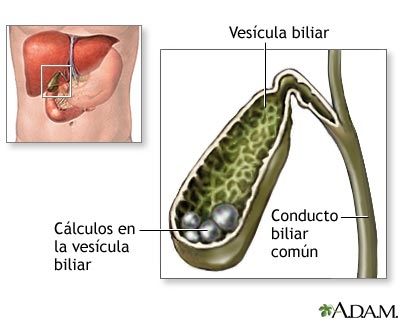 Colelitiaza