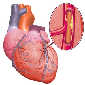 Ldl colesterol