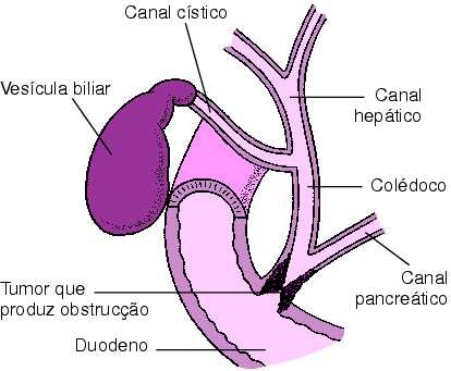 Colicistitele acute - bolile veziculei biliare