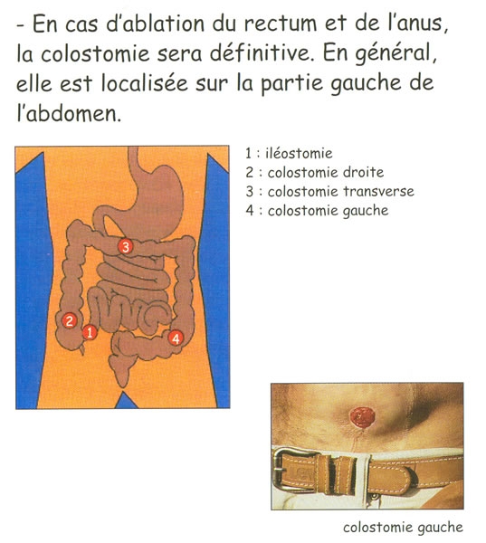 Colostomie (anus contra naturii)