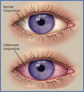 Alte cauze ale ochiului rosu - corneea si conjunctiva