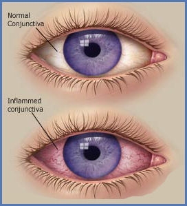 Pterygium of conjunctiva and cornea