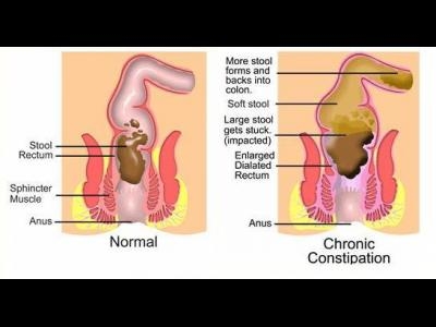 Diareea, constipatia si malabsorbtia