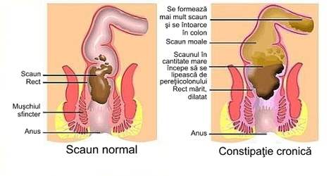 Constipatie