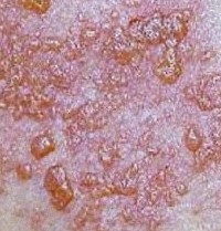 Dermatoze precanceroase